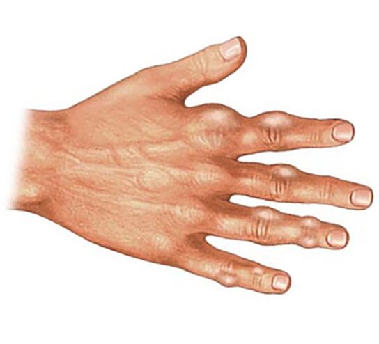Gut artritinde parmakların yumuşak dokularında ürik asit kristallerinin birikmesi