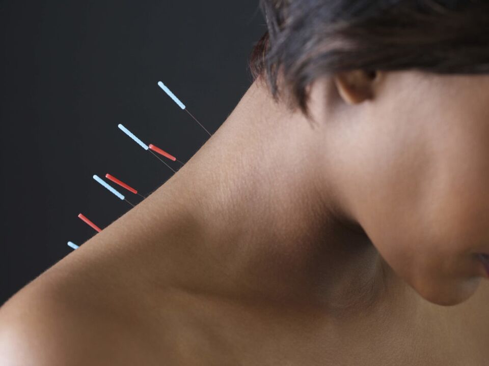 Servikal osteokondroz için akupunktur, inflamatuar süreçleri ortadan kaldırır