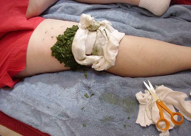 Osteoartrit ile ağrıyan diz eklemi üzerine sıcak bir kompres lahana püresi yaprağı